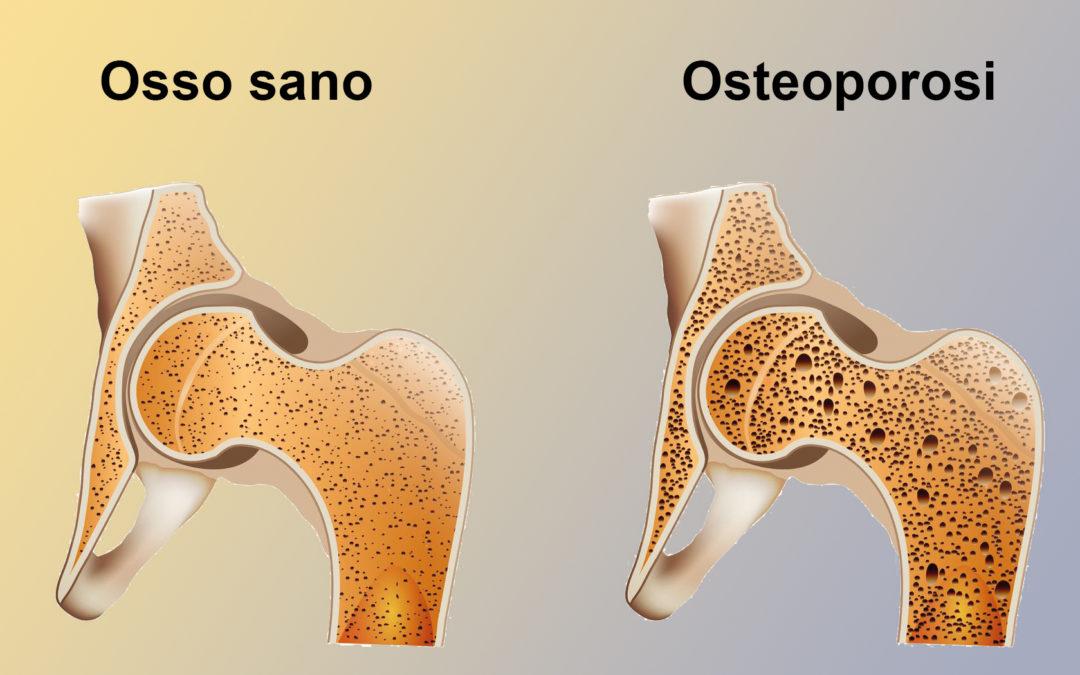 Osteoporosi e invecchiamento - Medicinapertutti.it